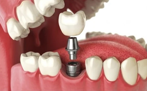 Ilustração de implante dentário